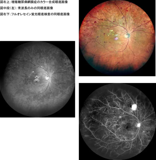 糖尿病網膜の等級分け