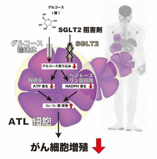 糖尿病治療薬が血液がんを抑制する可能性　SGLT2阻害薬が超難治性の血液悪性腫瘍の増殖を抑える
