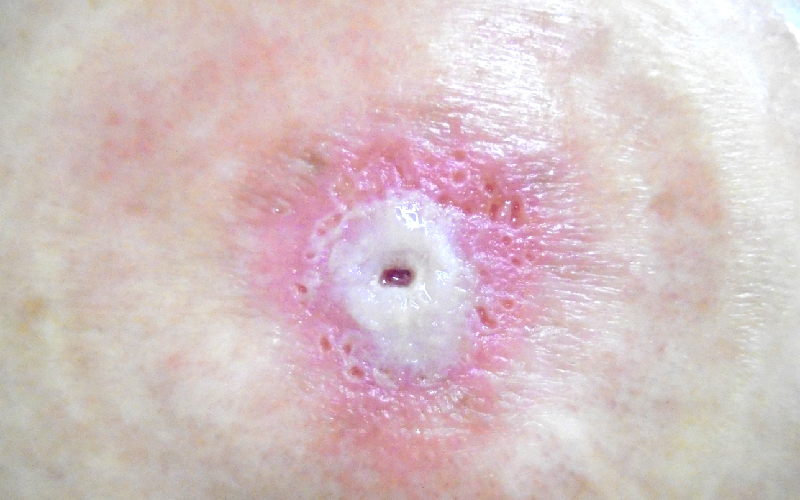 写真1：ふやけた皮膚の例