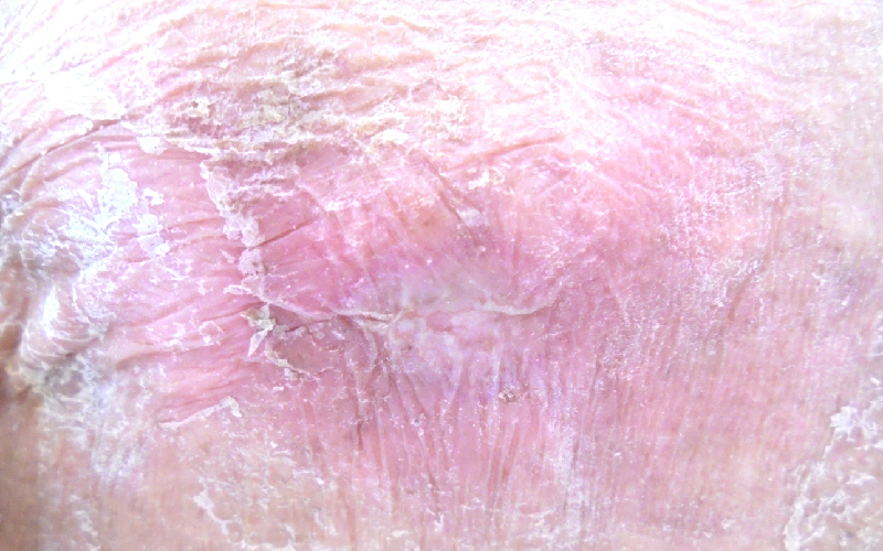 写真2：弱くなった皮膚の例