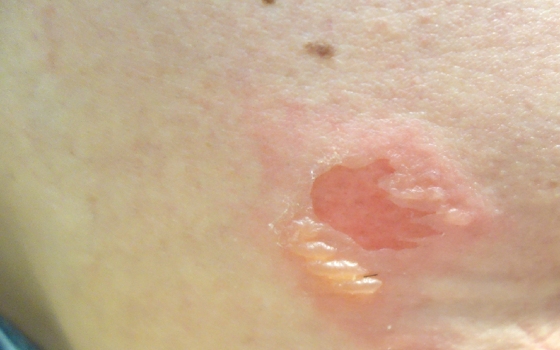 写真3：皮膚がむけた例