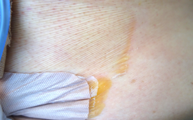 写真4：水ぶくれの例