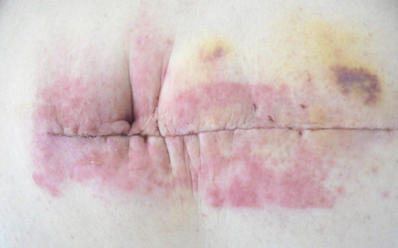 写真５：アレルギー反応の例