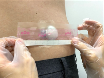 フィルムドレッシングの貼付